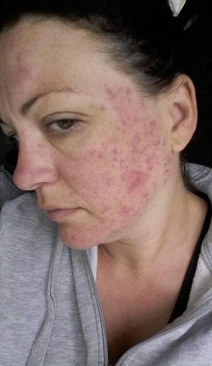 the best acne treatment for adult skin The Blissful Beauty Company SkinBase 1