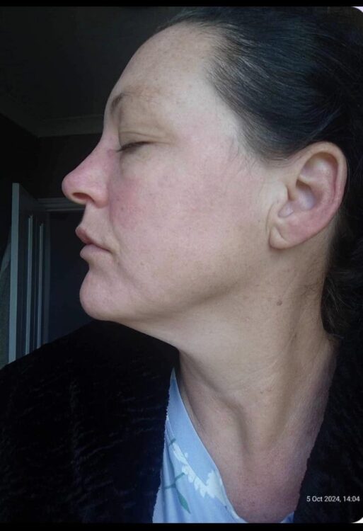 the best acne treatment for adult skin The Blissful Beauty Company SkinBase 2