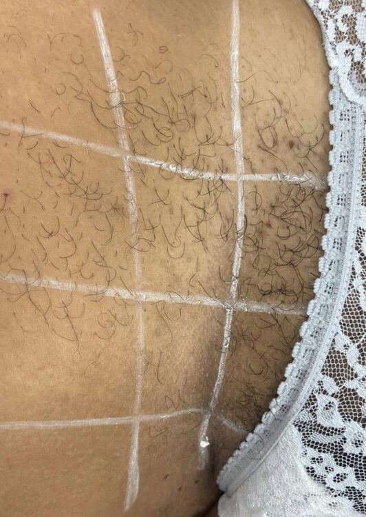 the best comfortable unwanted hair removal treatment SkinBase IPL results 1