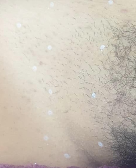 the best comfortable unwanted hair removal treatment SkinBase IPL results 2