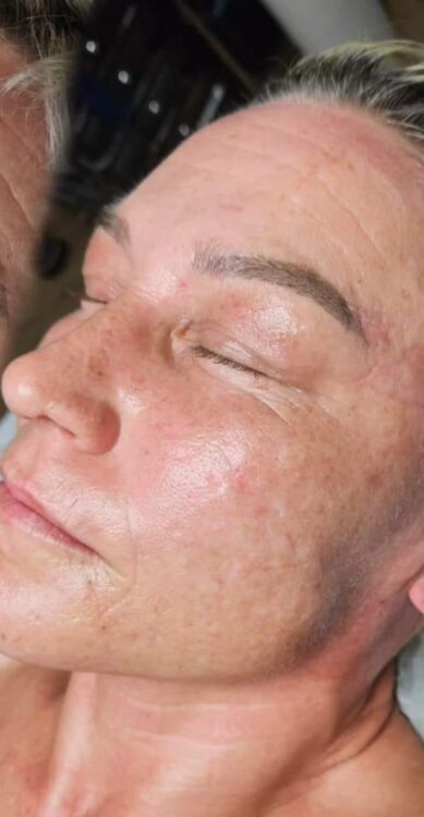 the best confidence boosting facial SkinBase IPL and Collagen Lift ULTIMATE Filly Green 2