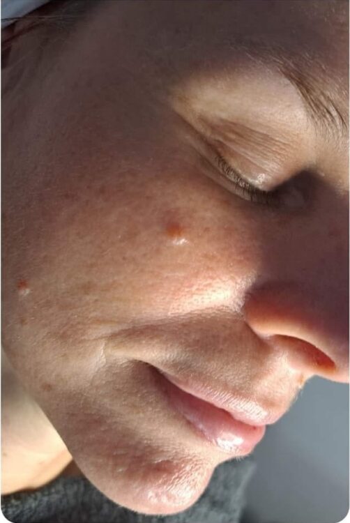 the best facial treatment for a youthful glow before and after microdermabrasion SkinBase Soul Touch 1