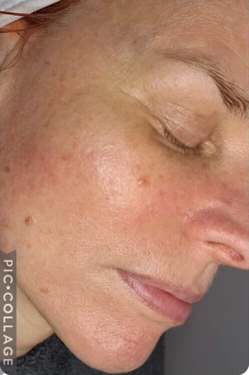 the best facial treatment for a youthful glow before and after microdermabrasion SkinBase Soul Touch 2