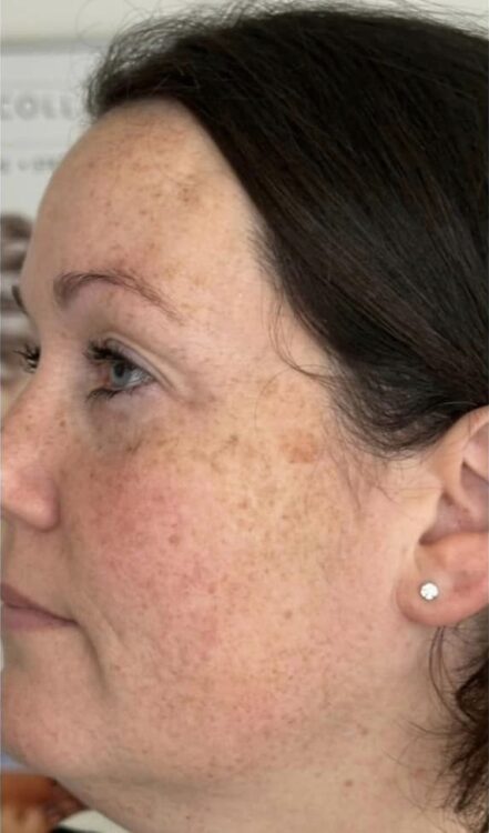 the best facial treatment for hormonal skin microdermabrasion results 2bSpoilt 1