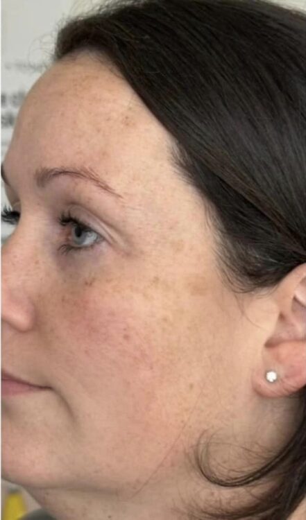 the best facial treatment for hormonal skin microdermabrasion results 2bSpoilt 2