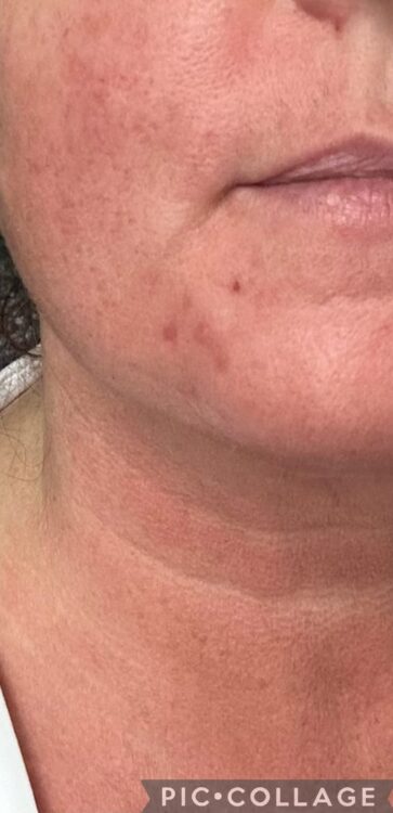 the best neck and jawline treatment bare beauty 2