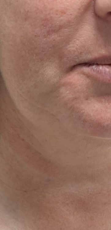 the best neck and jawline treatment radio frequency bare beauty 1