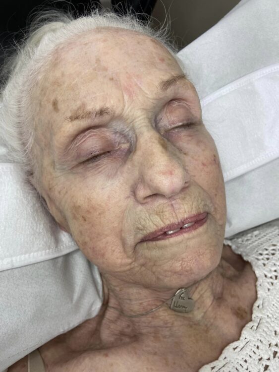 the best non-surgical facial for glowing healthy skin Beautybycharli 1