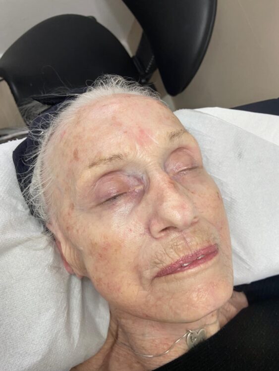 the best non-surgical facial for glowing healthy skin Beautybycharli 2