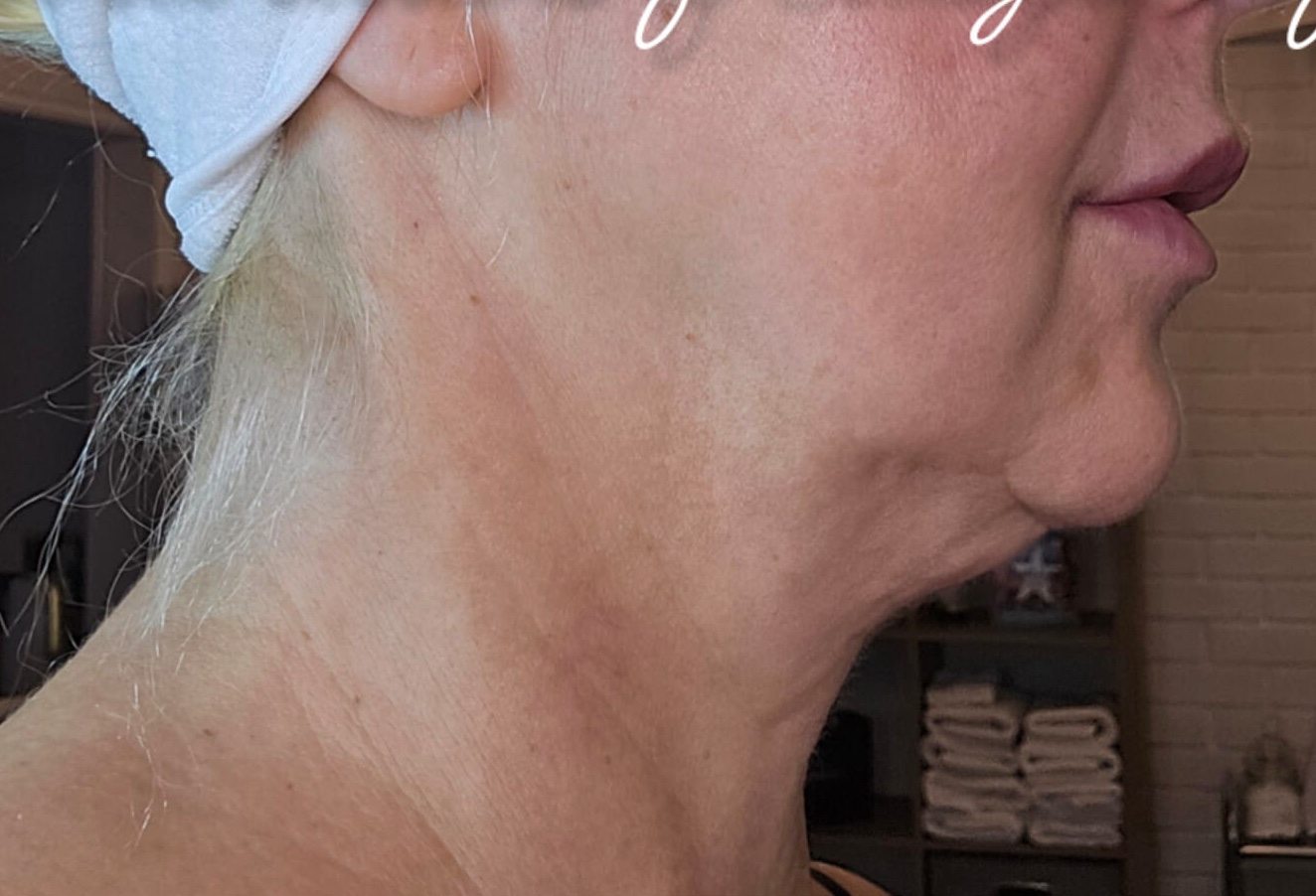 the best non-surgical neck lift treatment before and after SkinBase Collagen Lift Ice Aesthetics 1