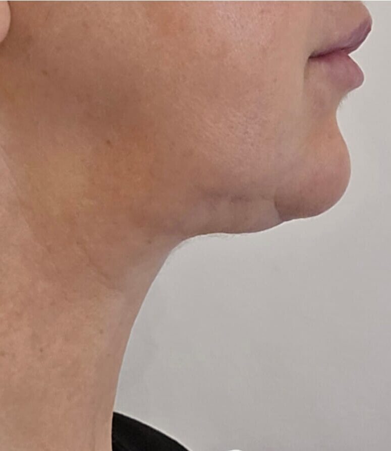the best non-surgical neck lift treatment before and after SkinBase Collagen Lift Ice Aesthetics 2