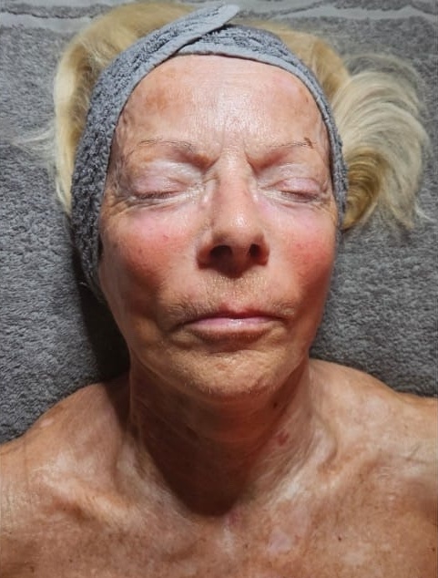 the best smoothing face and neck treatment results SkinBase Collagen Lift radiofrequency Lisa Burke Health & Beauty 2