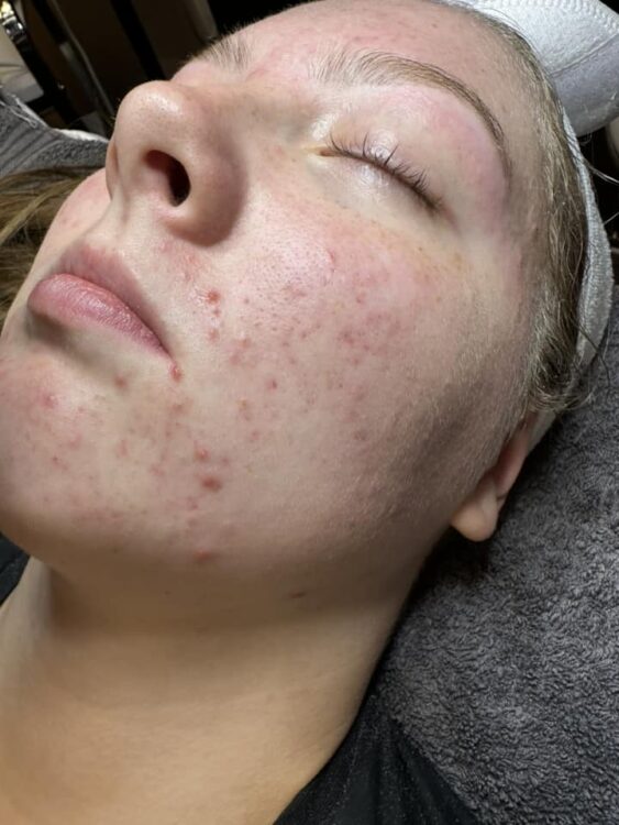 the best treatment for acne before and after microdermabrasion Bronze Inc 1