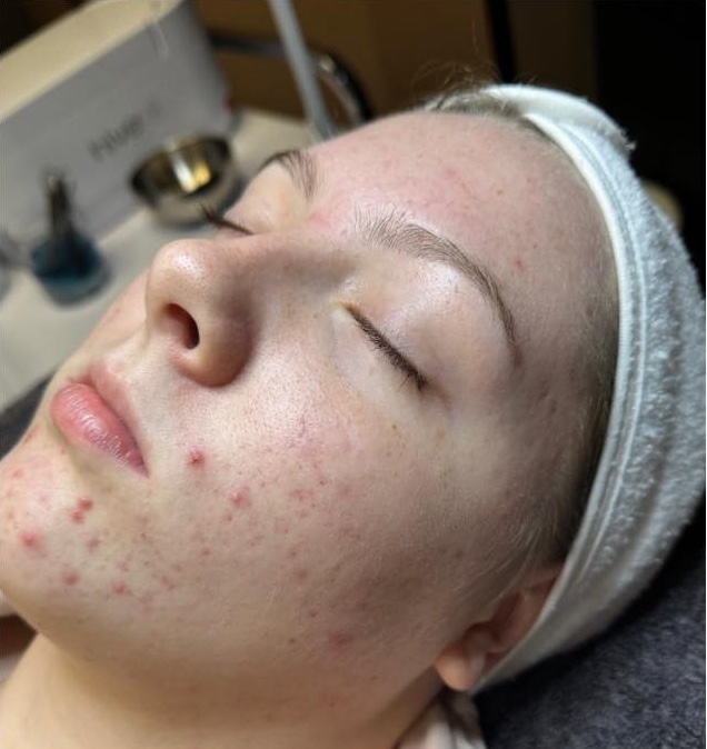the best treatment for acne before and after microdermabrasion Bronze Inc 2