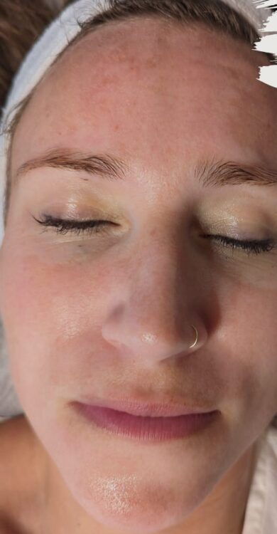 the best treatment for sun damage SkinBase Microdermabrasion gaby massage and beauty 1