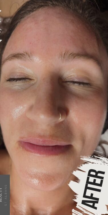 the best treatment for sun damage SkinBase Microdermabrasion gaby massage and beauty 2
