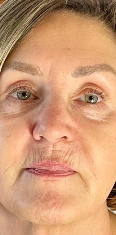 the ultimate sagging jowls treatment results SkinBase Bijou Beauty Room 1