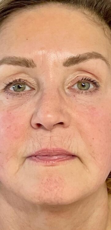 the ultimate sagging jowls treatment results SkinBase Bijou Beauty Room 2