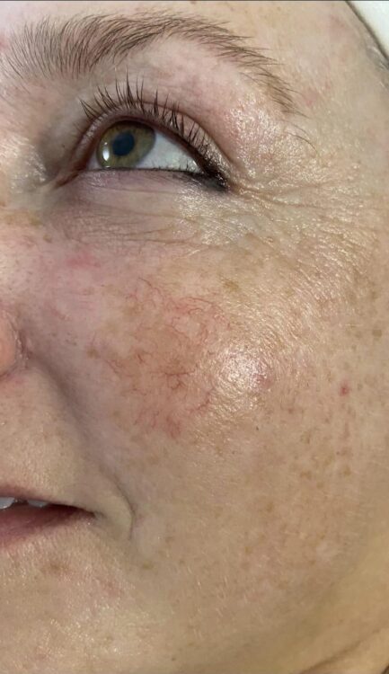 vascular veins treatment before and after intense pulsed light SkinBase Lauren's Beauty & Massage 1