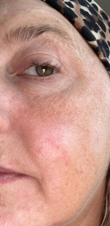 vascular veins treatment before and after intense pulsed light SkinBase Lauren's Beauty & Massage 2