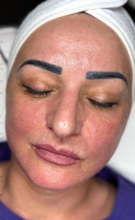 before and after rejuvenating collagen facial January B One Aesthetics