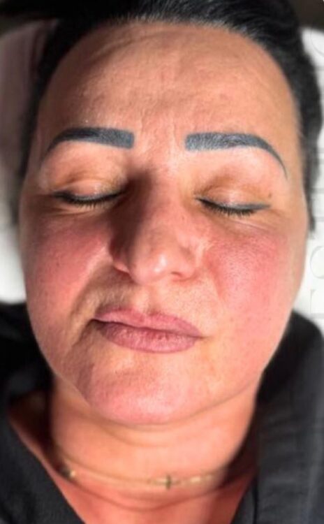 before and after rejuvenating collagen facial January B One Aesthetics