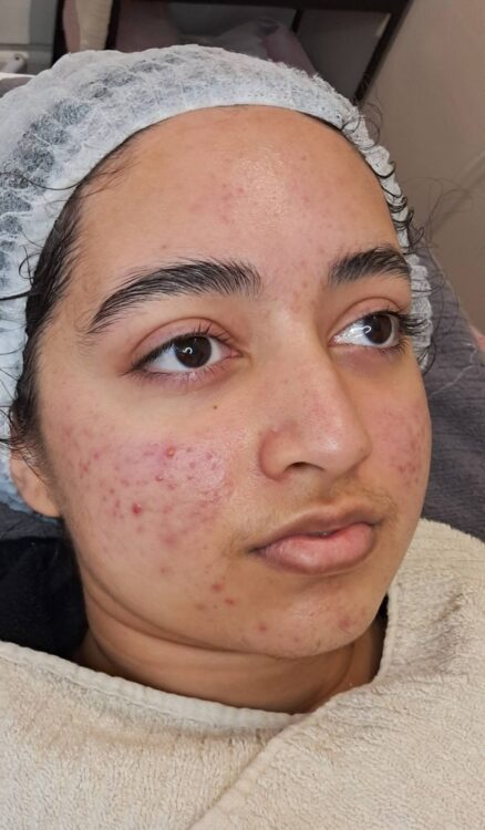 before and after microdermabrasion for acne scarring January Belle Aimee Beauty