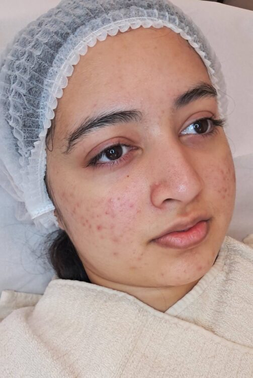 before and after microdermabrasion for acne scarring January Belle Aimee Beauty