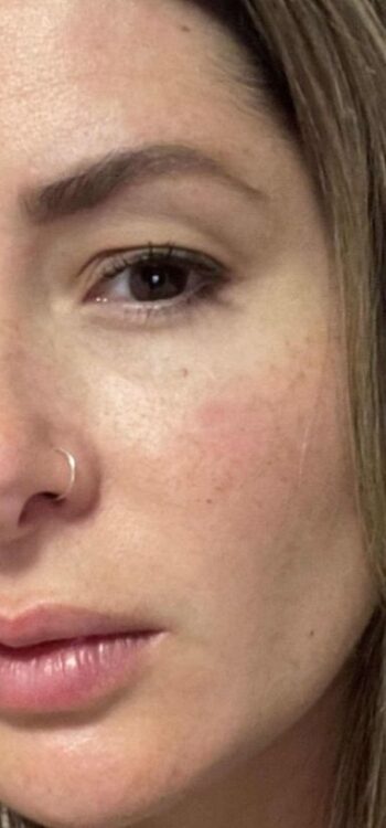 ipl for pigmentation results January Blissful Beauty by Clare