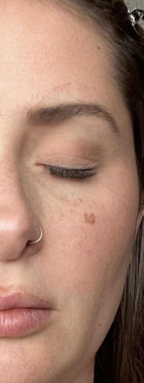 ipl for pigmentation results January Blissful Beauty by Clare