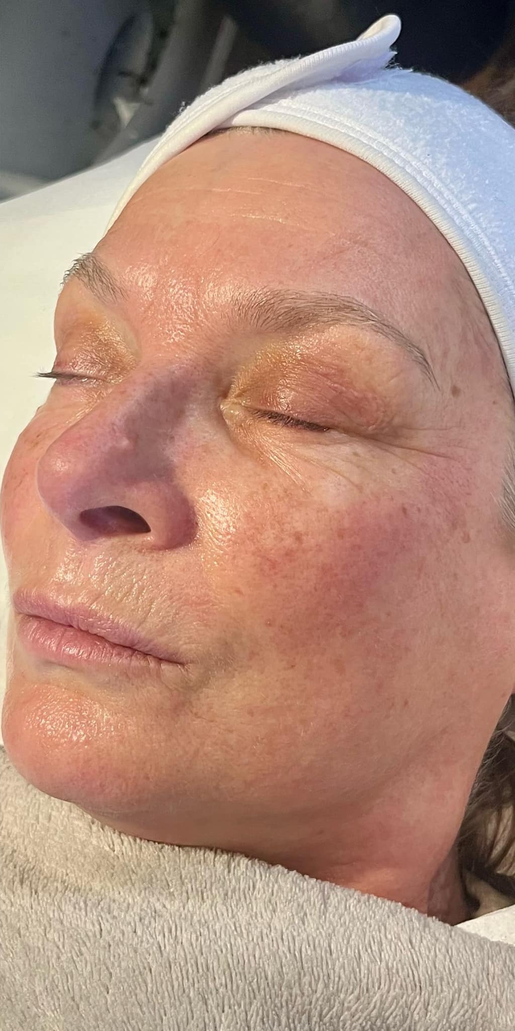 the best refreshing facial skinbase microdermabrasion results byemilyfrancesca January