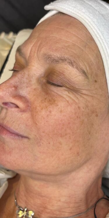 the best refreshing facial skinbase microdermabrasion results byemilyfrancesca January
