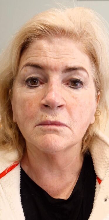 neck rejuvenation treatment before and after SkinBase Collagen Lift January Clare Brennan Beauty