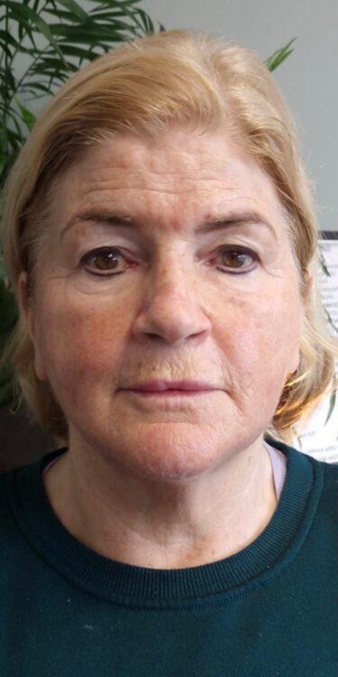 neck rejuvenation treatment before and after SkinBase Collagen Lift January Clare Brennan Beauty
