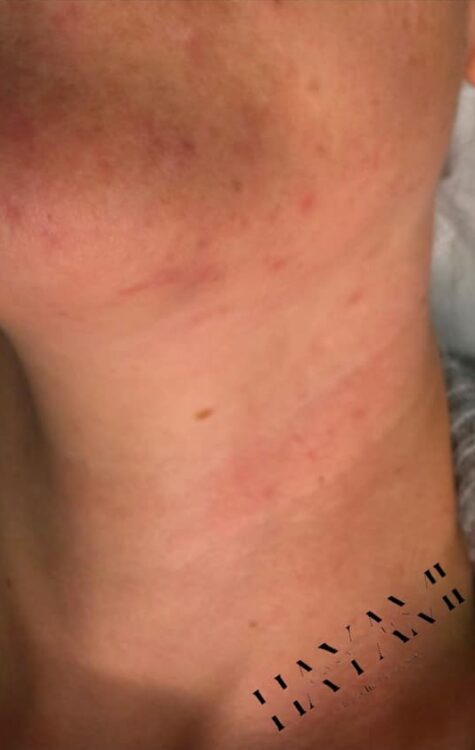 intense pulsed light for acne results January Hayami Cosmetics