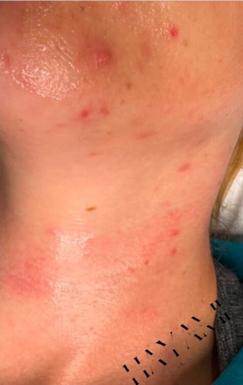 intense pulsed light for acne results January Hayami Cosmetics
