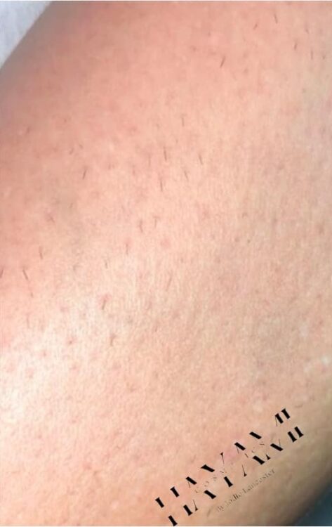 unwanted hair removal results SkinBase IPL legs treatment January Hayami Cosmetics