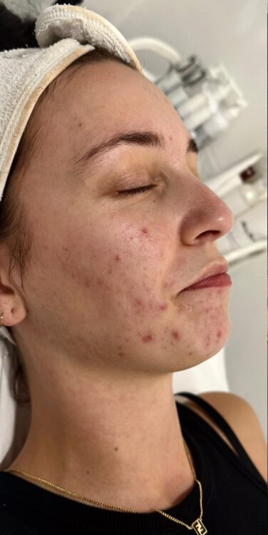 the best facial for acne prone skin skinbase hydro before and after January Katherine Monique Beauty