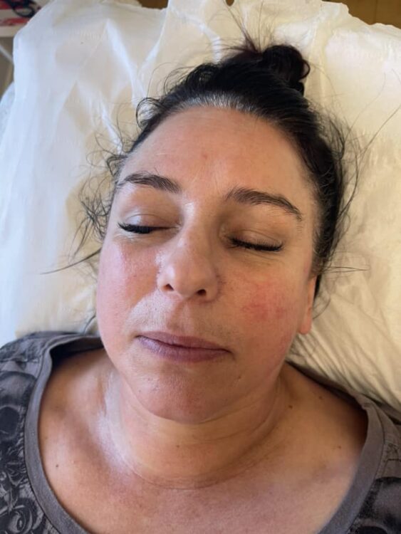 radio frequency facial and microdermabrasion results January LM Beauty