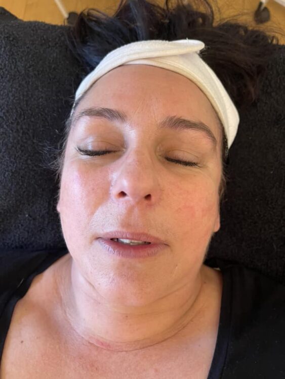 radio frequency facial and microdermabrasion results January LM Beauty