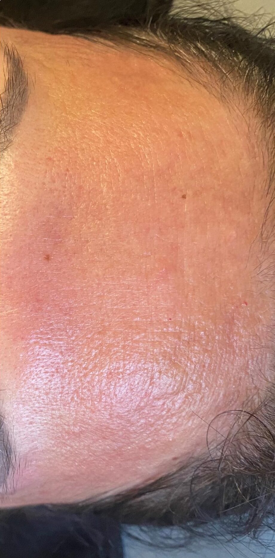 the best treatment for sun damage on the forehead SkinBase radio frequency January Lotus Beauty