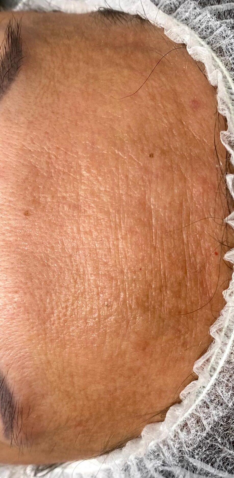 the best treatment for sun damage on the forehead SkinBase radio frequency January Lotus Beauty