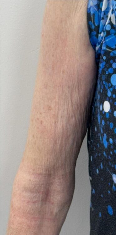 radio-frequency arm treatment before and after January Revive Health and Beauty