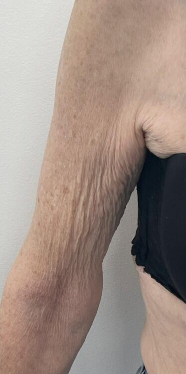 radio-frequency arm treatment before and after January Revive Health and Beauty