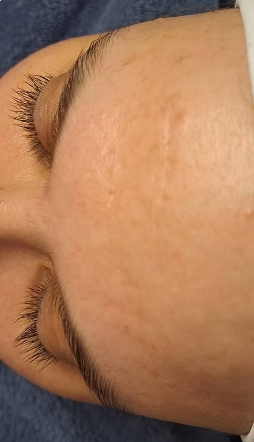 microdermabrasion for acne and blemishes January Soul Touch