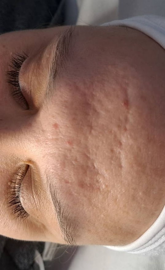 microdermabrasion for acne and blemishes January Soul Touch