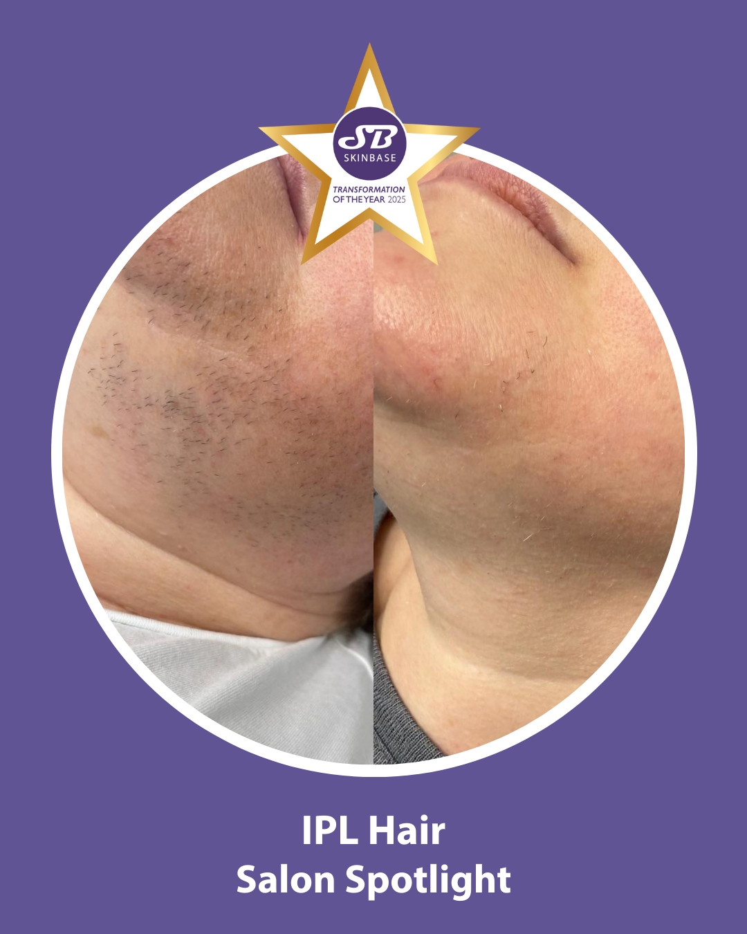 Treating Unwanted Hair with SkinBase IPL & Nicola Wood