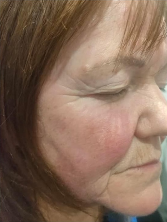 April Beauty Within Durham Collagen Lift radio frequency for ageing skin rejuvenating facial after