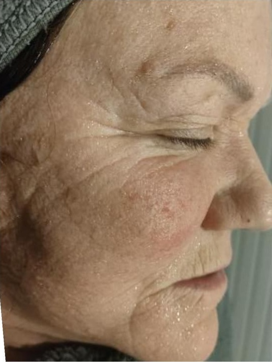 April Beauty Within Durham Collagen Lift radio frequency for ageing skin rejuvenating facial before