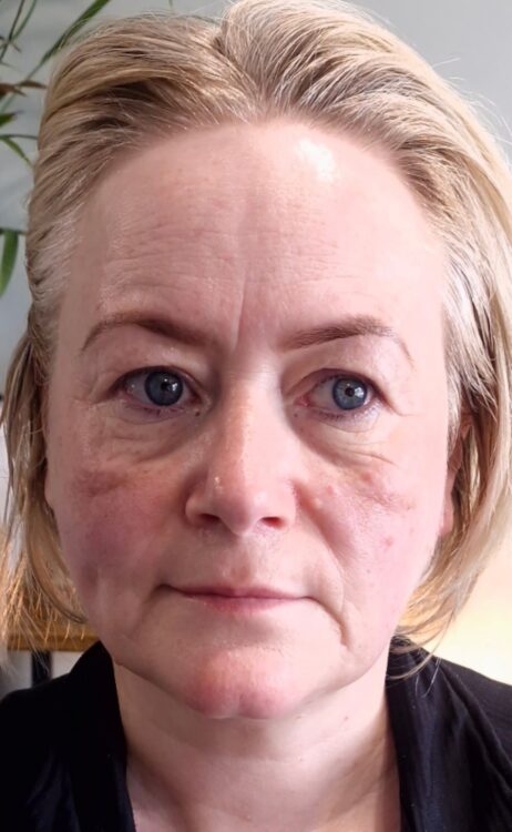 April Clare Brennan Beauty Collagen Lift ageing skin refresh radio frequency after